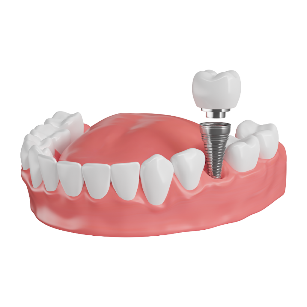 implante corona mostoles