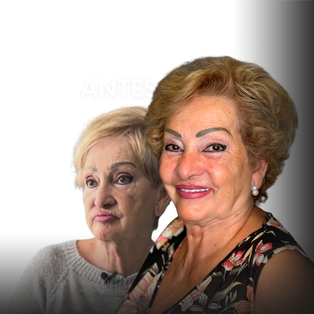 implantes dentales sin hueso resultados