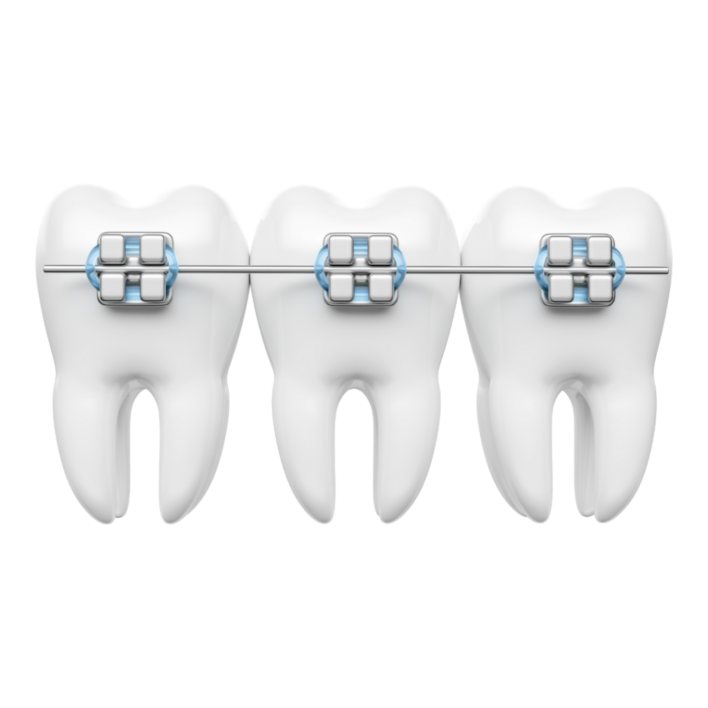 ortodoncia brackets