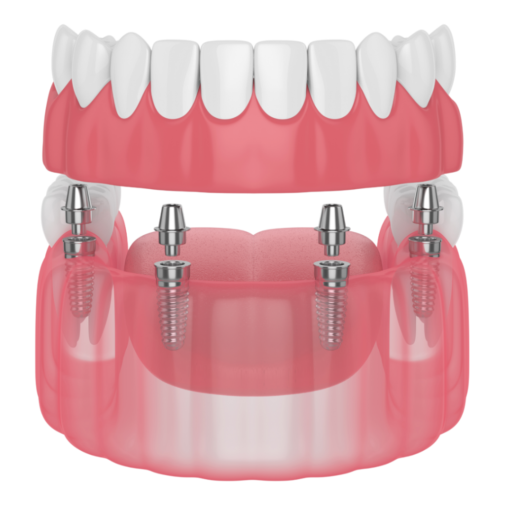 protesis sobre implantes mostoles