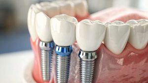 duele ponerse un implante dental - diandro dental clinica en navalcarnero