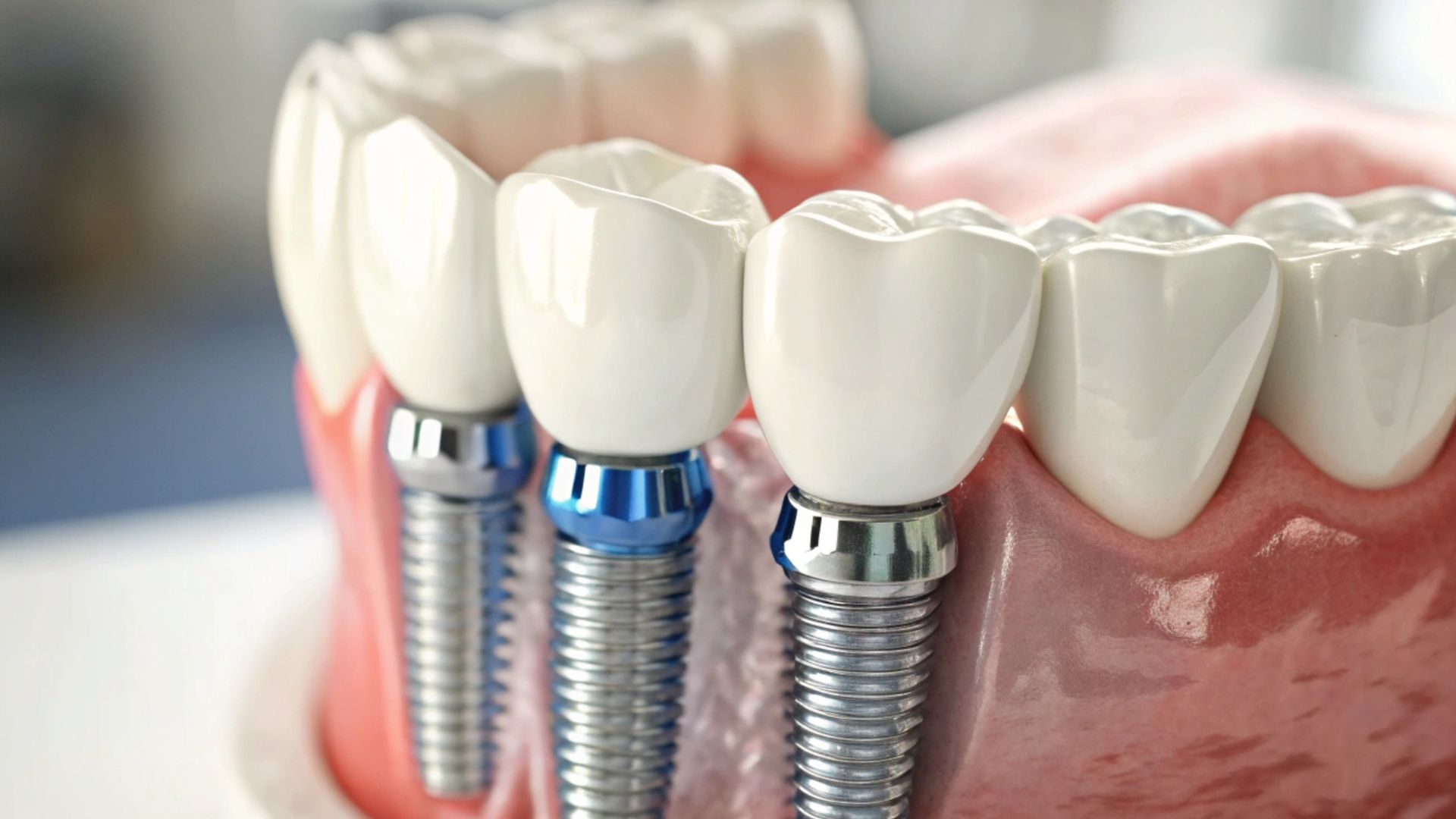 duele ponerse un implante dental - diandro dental clinica en navalcarnero